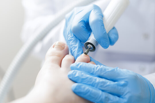 Podiatrist treats patient toenails with precision and care