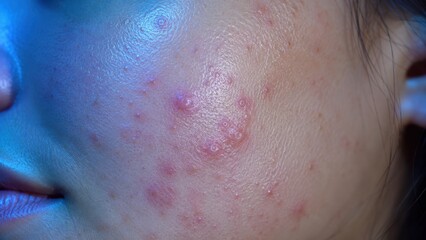Fototapeta premium Close-up of young woman’s cheek with inflamed acne and red blemish skin condition on face