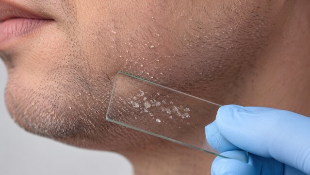 Closeup of skin flakes on male chin being tested on glass slide under examination with blue glove