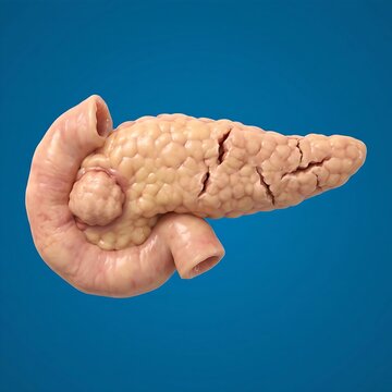 A realistic human pancreas featuring a distinct tumorous mass and surface fractures, centered 
