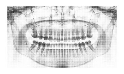 Halftone style dental panoramic xray showing human teeth and jaw structure © mstMazeda