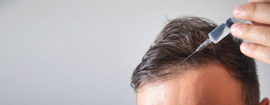 Making injection in the man head for hair growth.