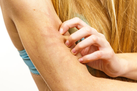 Woman scratching her itchy arm. Skin allergy.