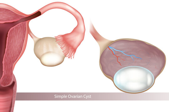 Medical illustration of a simple ovarian cyst showing a smooth, fluid-filled cyst arising from the ovary, with the uterus, fallopian tube, ovary, fimbriae and pelvic anatomy visible.