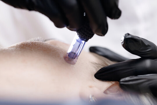 Woman receiving microneedling treatment on forehead in clinic