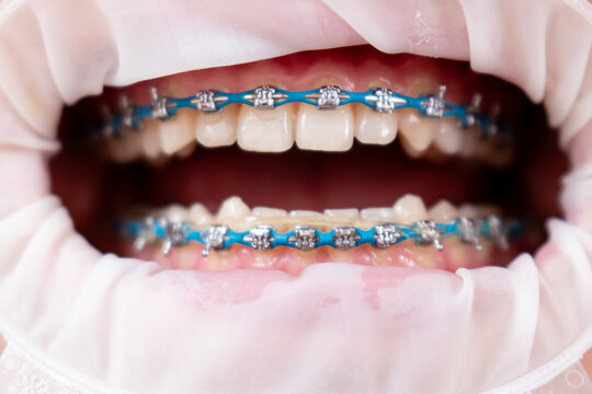 Close-up of metal braces with blue elastic ligatures on a patient's teeth during orthodontic treatment. Modern dentistry, bite correction and teeth alignment concept.