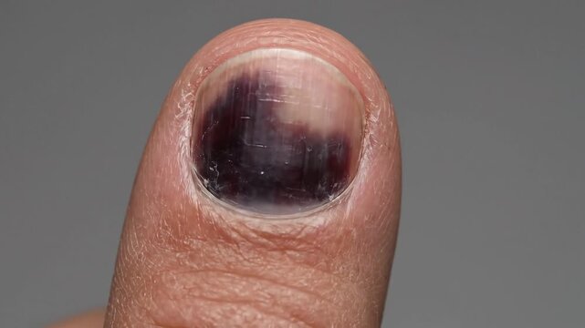 A subungual hematoma, dark purple-black bruising under the fingernail