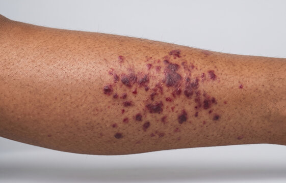 Close Up of Severe Purpura Vasculitis Hematoma on Dark African American Skin