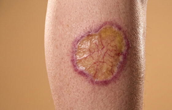 Close Up of Necrobiosis Lipoidica Diabeticorum and Skin Ulceration on Patient Lower Leg