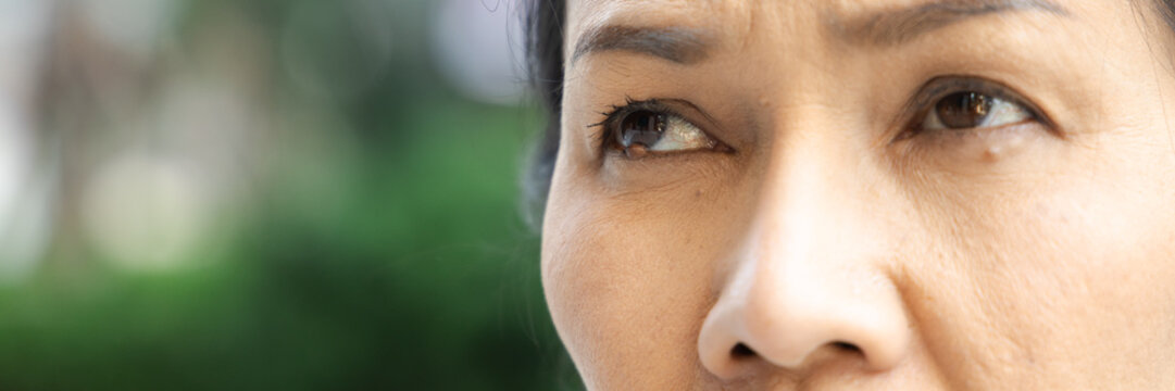 Middle aged Asian woman looking up, having eyelid bump condition, eye closeup shot