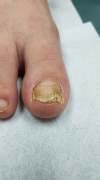 Toe infection pathology: fungus damage, nail decay, unhealthy skin, yellow discoloration, dermatological condition, onychomycosis symptom, medical issue, dry keratin, diseased foot.
