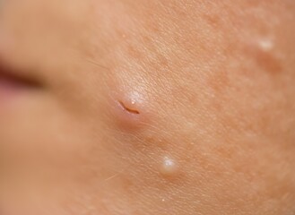 Fototapeta premium Macro View of Skin Blemish and Clogged Pore on Human Face, concept of dermatological health and skin imperfections