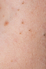 Fototapeta premium Close up acne on skin. Inflamed skin bumps acne macro. Irritated skin with pimples acne texture. Detailed skin with acne.