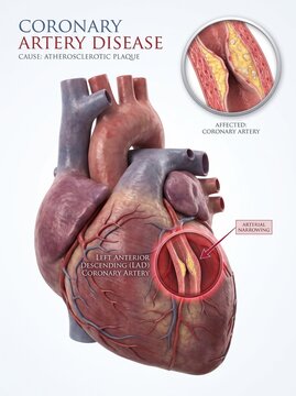 Coronary Artery Disease Medical Illustration showing Heart Anatomy and Atherosclerotic Plaque Narrowing