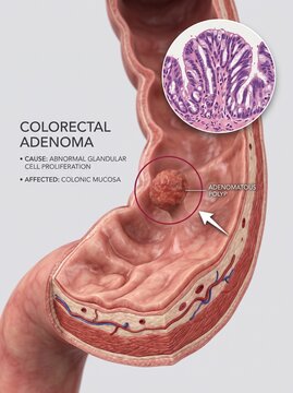 Colorectal Adenoma Medical Illustration Showing Adenomatous Polyp and Histology View