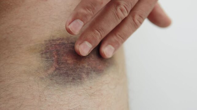 Touching dark purple bruise on thigh with fingers. Man touching injured hairy leg skin after fall. Large hematoma after trauma, close up.
