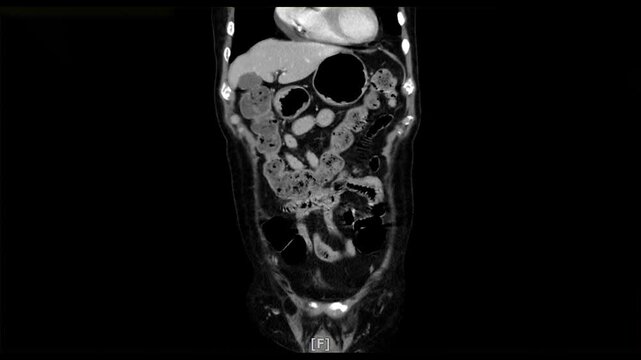 body scan motion by mri ct scan to show internal organs x-ray and Liver,Lungs,Intestines,Stomach,Bladder,Kidneys. 