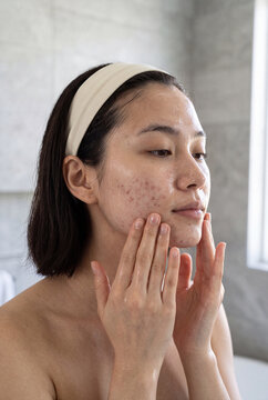 Young woman with acne examining skin and applying treatment for dermatology skincare educational banner and health background