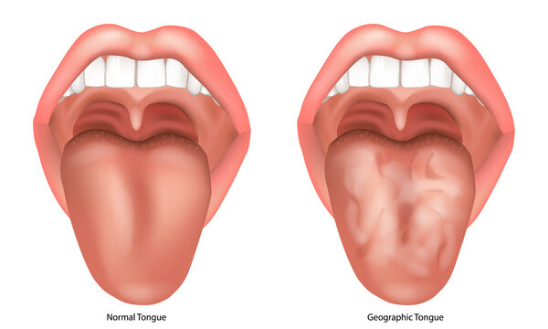 Geographic Tongue and Normal Tongue Comparison Medical Illustration.  Benign Migratory Glossitis.  Open mouth anatomy showing characteristic irregular smooth patches on the tongue surface