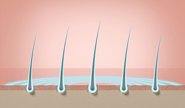 Multiple glowing healthy hair strands growing from skin follicles - 3d illustration