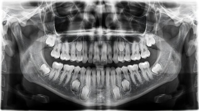 Dental panoramic X-ray showing full set of teeth.