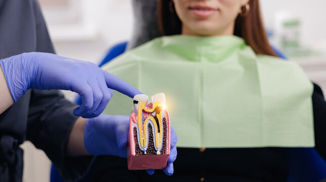 Female patient learning about caries and pulpitis of nerve canal of tooth model in clinic and structure at dental clinic