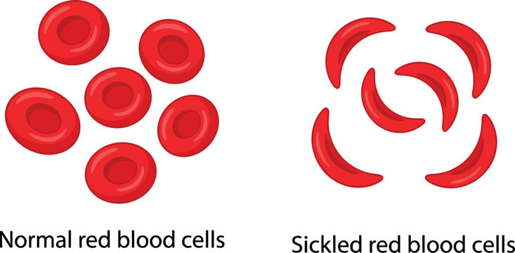Medical vector illustration comparing normal red blood cells and sickled red blood cells