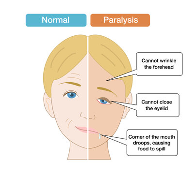 Anatomical Illustration Comparing Facial Asymmetry and Symptoms Caused by Facial Nerve Palsy
