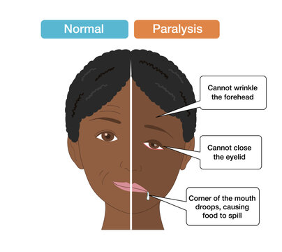 Anatomical Illustration Comparing Facial Asymmetry and Symptoms Caused by Facial Nerve Palsy