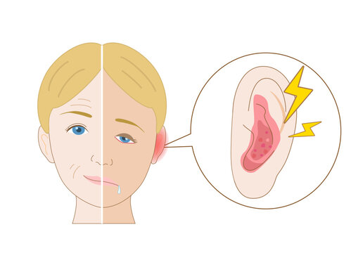 Anatomical Diagram Explaining Ramsay Hunt Syndrome Symptoms Caused by Varicella-Zoster Virus