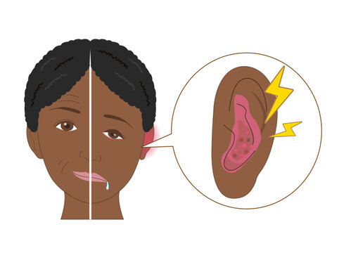 Anatomical Diagram Explaining Ramsay Hunt Syndrome Symptoms Caused by Varicella-Zoster Virus