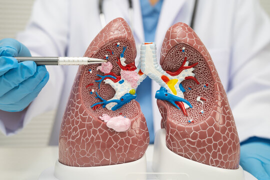 Pneumonia, lung cancer, Asian doctor with human lung model.