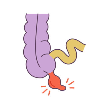 Medical Illustration of Appendicitis Showing Inflammation of the Human Appendix Organ