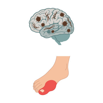 Medical illustration showing a human brain with spots and a swollen painful big toe representing gout