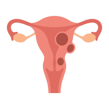 Flat vector illustration of a human uterus showing uterine fibroids or benign tumors on the organ wall