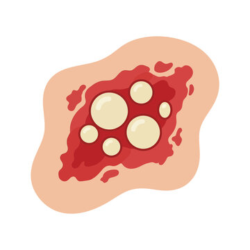 Vector illustration of an infected skin wound with yellow pus blisters and red inflamed dermal tissue