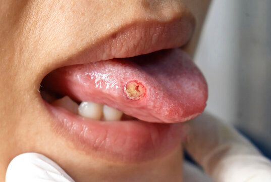 A painful aphthous ulcer with a yellowish center and red inflammatory halo on the lateral border of a tongue of an Asian female patient during a clinical medical examination.