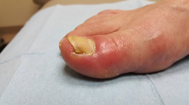 Medical close-up of an inflamed big toe with paronychia and an ingrown toenail on a clinical drape.