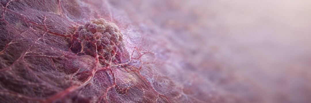 Cancer tumor growing through vascular tissue, oncology disease progression concept for medical website banner with copy space
