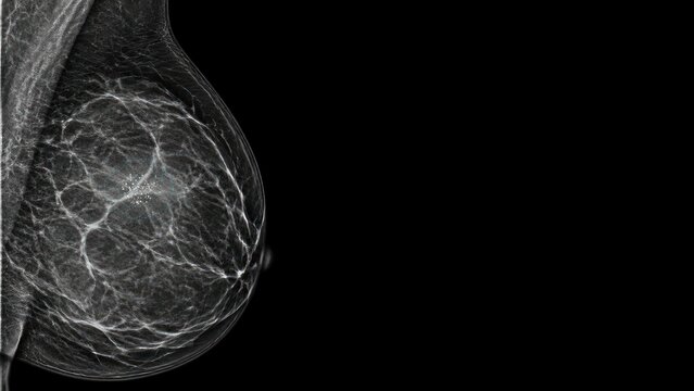 Breast mammogram showing dense tissue, cancer screening concept for medical diagnostics with copy space