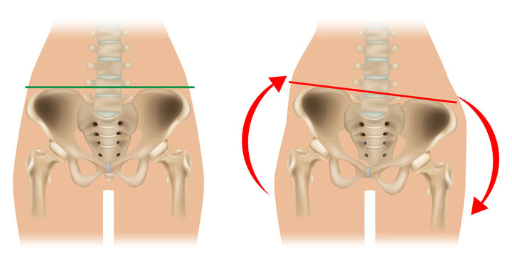 Pelvic Obliquity and Hip Imbalance Medical Anatomy Illustration. Normal and Tilted Pelvis Comparison Showing Pelvic Misalignment. Pelvic Tilt and Asymmetry of Hip Position 