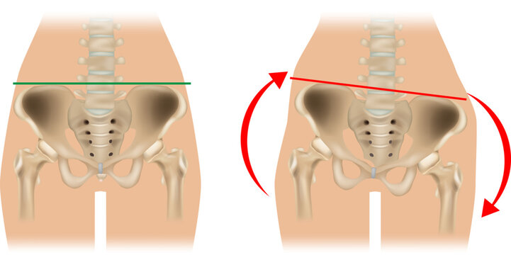 Pelvic Obliquity and Hip Imbalance Medical Anatomy Illustration. Normal and Tilted Pelvis Comparison Showing Pelvic Misalignment. Pelvic Tilt and Asymmetry of Hip Position 