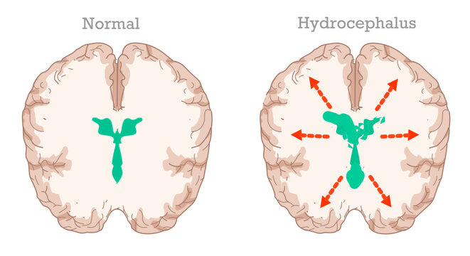 Hydrocephalus is a condition caused by the accumulation of cerebrospinal fluid in the brain. Cross section anatomy. Top view. Illustration vector 