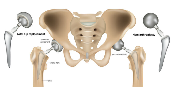 Detailed medical anatomical illustration comparing total hip replacement with hip hemiarthroplasty. The diagram shows the pelvis, femur, hip joint and orthopedic prosthetic implants. 