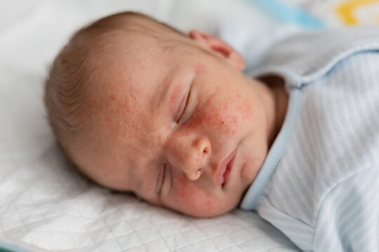 Close up of a sleeping newborn baby with red skin rash or neonatal acne on cheeks and forehead.
