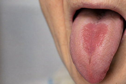 Geographic Tongue with Smooth Depapillated Red Patch