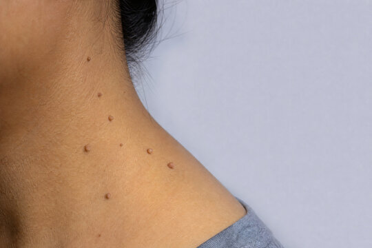 Skin Tags on the Neck in Adult Skin