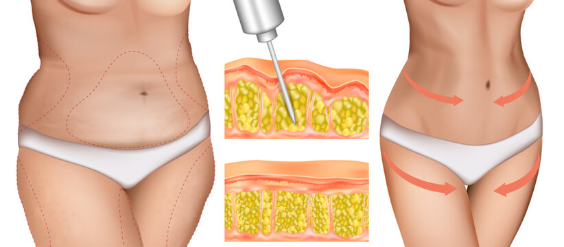 Medical illustration of semaglutide GLP-1 injection for obesity treatment and weight management. Female body before and after weight loss with subcutaneous injection, adipose tissue and reduced body f