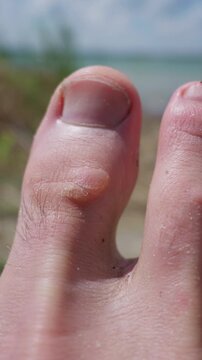 A detailed close-up shows a painful friction blister on the joint of a male big toe with sand grains on the skin. Concept of skin damage, hiking injuries, and dermatological conditions.
