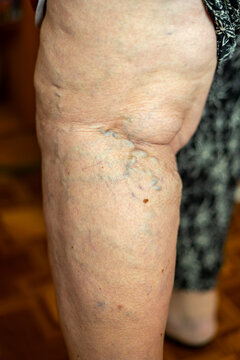 Varicose Veins on Older Adult Leg and Knee. Close-up of an older adult leg and knee showing prominent varicose veins, blue-green superficial vessels, wrinkled skin, small pigmented spots.